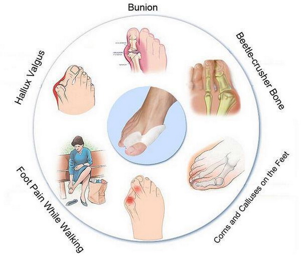 ซิลิโคนคั่นนิ้วเท้า (นิ้วโป้ง/นิ้วชี้) (x3 คู่)