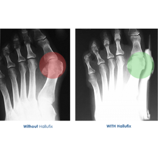 ซิลิโคนคั่นนิ้วเท้า (นิ้วโป้ง/นิ้วชี้) (x3 คู่)